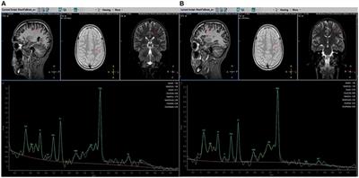 Metabolite profile in hereditary spastic paraplegia analyzed using magnetic resonance spectroscopy: a cross-sectional analysis in a longitudinal study